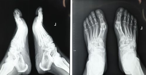 大脚骨治疗可不是单纯祛除骨突这么简单