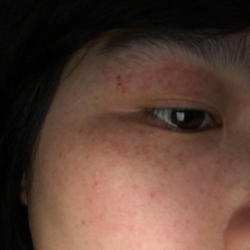 眼睛上下眼皮突然长了好多红点点