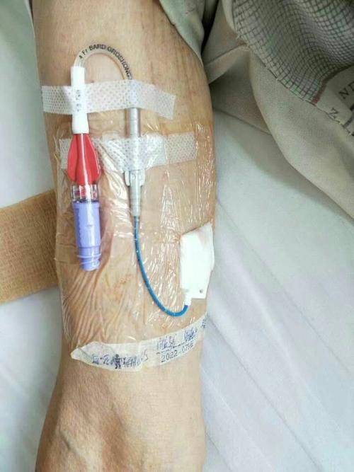 奋进中的普外科――picc