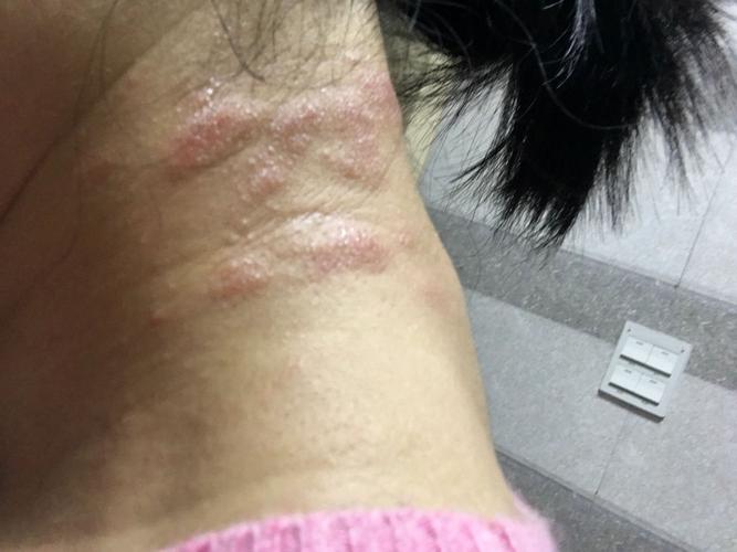 这是季节性皮炎吗?怎么办?