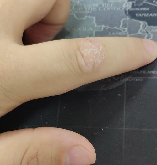手心和手指关节皮肤硬起角质层,掉皮.已经有半年多了.