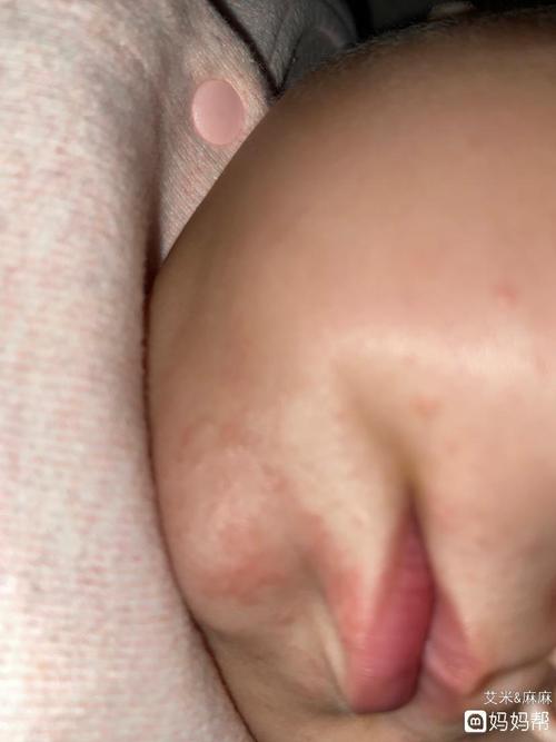 宝宝下巴和嘴角处都有硬硬的疙瘩  不知道是湿疹还是奶癣