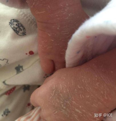 新生儿皮肤脱皮怎么办