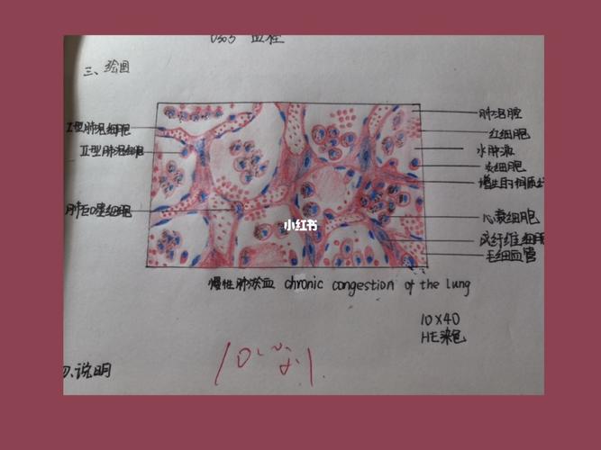 慢性肺淤血_医学生_医学生的日常_医疗健康_医疗健康