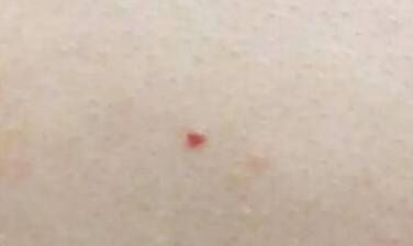 身上有这种小红痣千万别大意 是大病的预警信号