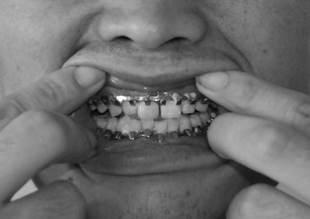 确诊为左下颌骨骨折,在该院由骨科医生做了下颌骨上臂骨折夹板固定