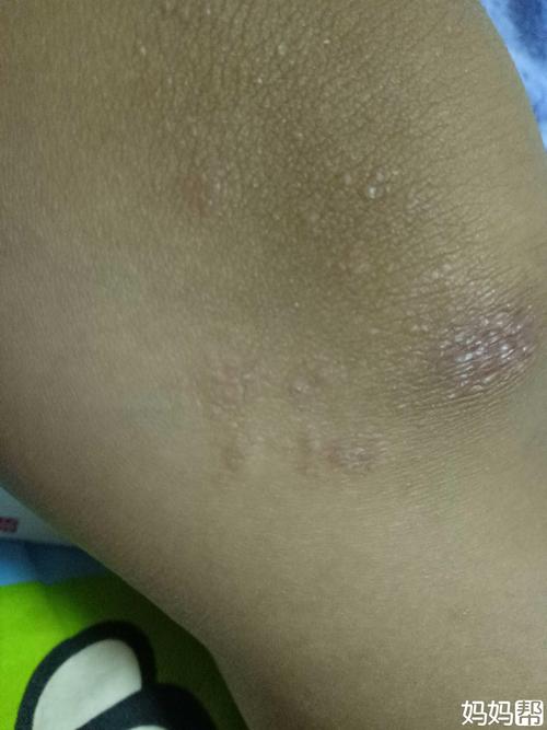 特应性皮炎该怎么治疗啊?