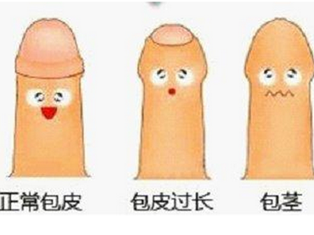 假性包皮过长