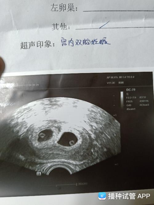 一超归来以见胎心胎芽双胎,移植囊胚28天血值8万多了,看这孕囊应该