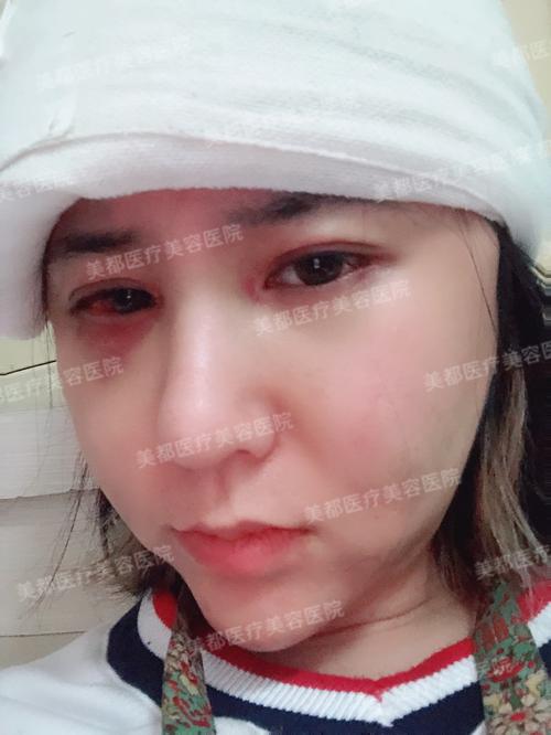 看了拆了绷带的效果,虽然脸还是肿的,但是脸型好看了,nice.