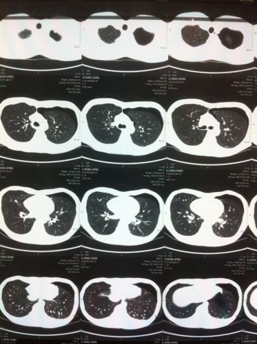 肺部ct图片,请问那些白色的小点点是什么东西啊?是肺大泡吗?