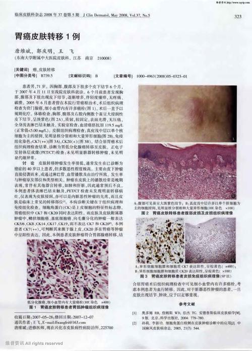 期刊胃癌皮肤转移1例被引量:2     患者男,71岁.