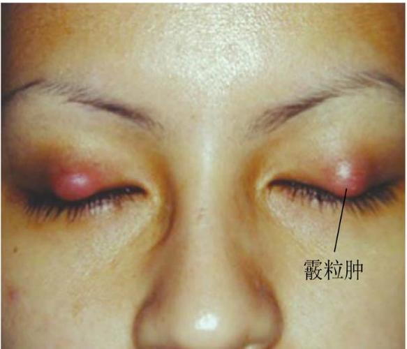 最主要的鉴别点是麦粒肿发病急,往往疼痛明显,而霰粒肿发病时间较长