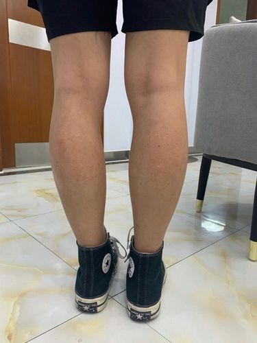 我的小腿是典型的脂包肌,减肥过程中能瘦的脂肪基本没_圈子-新氧美容