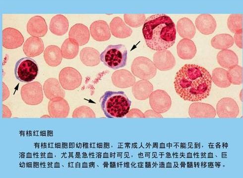 巨幼性细胞贫血有什么危害?