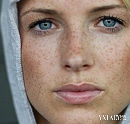 【图】晒斑和黄褐斑图片大全 这两者有何区别呢