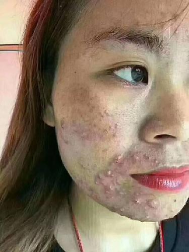 激素脸只会抓住3种人