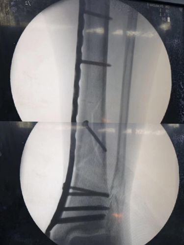 微创接骨板接骨术(mipo)在胫腓骨远端骨折中的应用