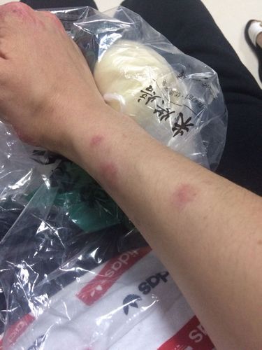 去医院检查说是真菌感染,但是我是养猫后长这些东西的