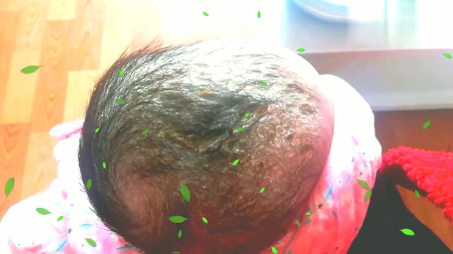 二宝头上胎脂严重,宝妈用橄榄油给她涂抹热敷,大家看下方法对不