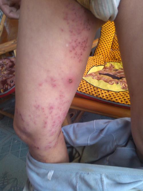 下肢内侧的疱疹基层医生求诊断