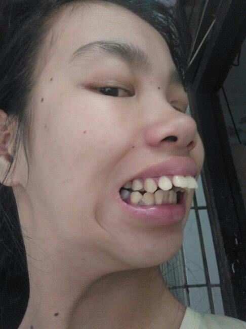 大龅牙很严重有什么办法吗