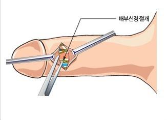 男性私密部位的手术治疗