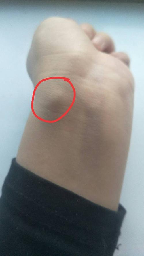 左手腕距脉搏不远处,时常会鼓起一个很明显的包,但是不疼不痒,用手按