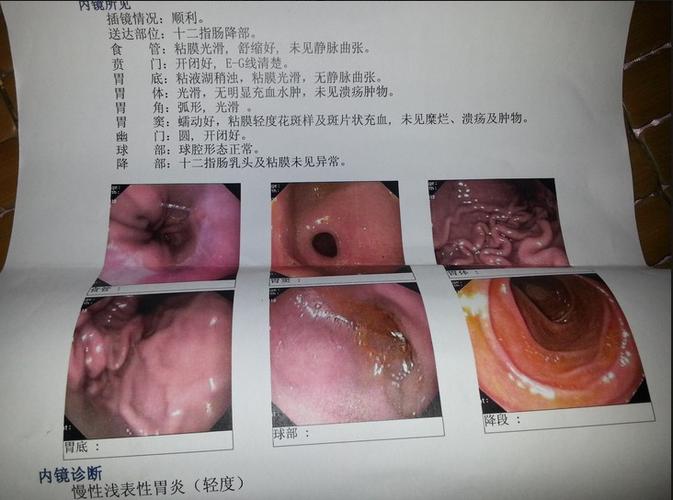慢性浅表性胃炎(轻度)
