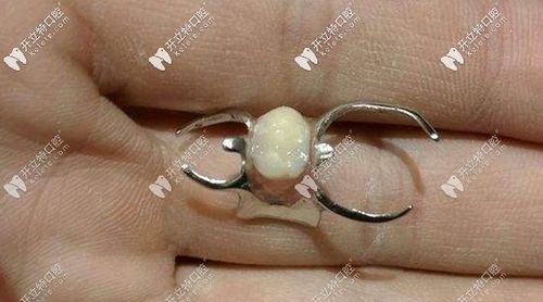 带挂钩的隐形义齿