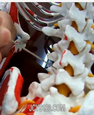 侧隐窝注射治疗根性痛腰椎间盘突出