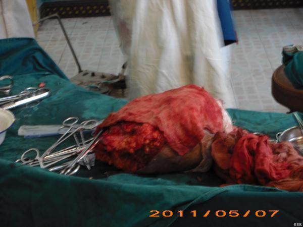 巨大乳腺肿瘤手术过程(图片)