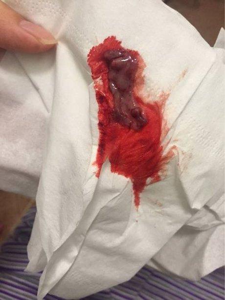 自然流产图片_360图片