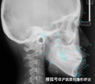 治疗前头颅侧位x光片