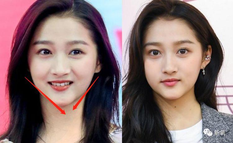 看下图,关晓彤的颧骨比下