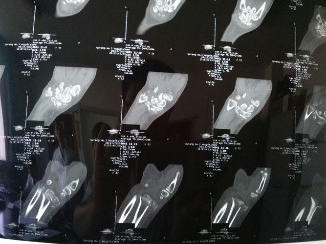 冠状位ct显示骨折粉碎为多个骨块,治疗难度较大.