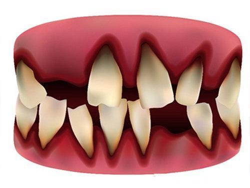 牙齿松动怎么办?绝对不能放任不管!