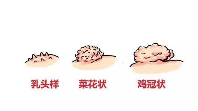 男性尖锐湿疣的症状是什么能否自愈