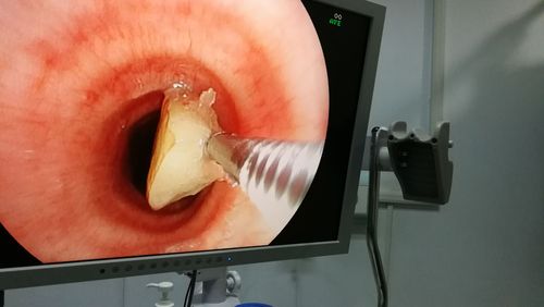 左主支气管内异物取出过程中.