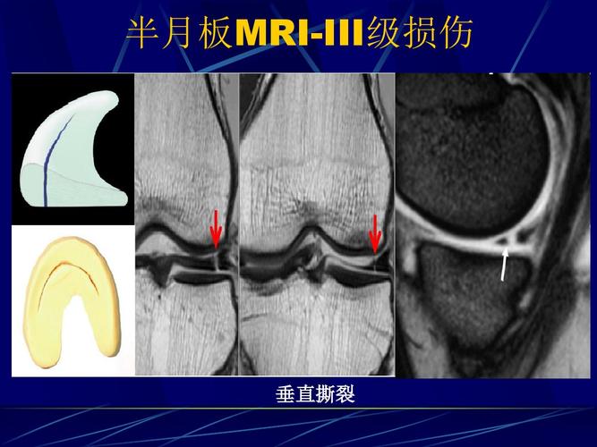 骨科基础丨半月板损伤磁共振表现