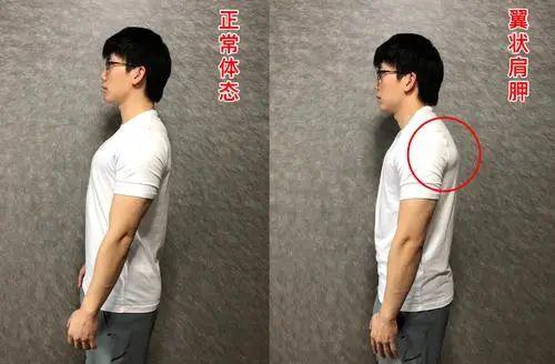 女性蝴蝶肩一个美丽的谎言如何康复治疗