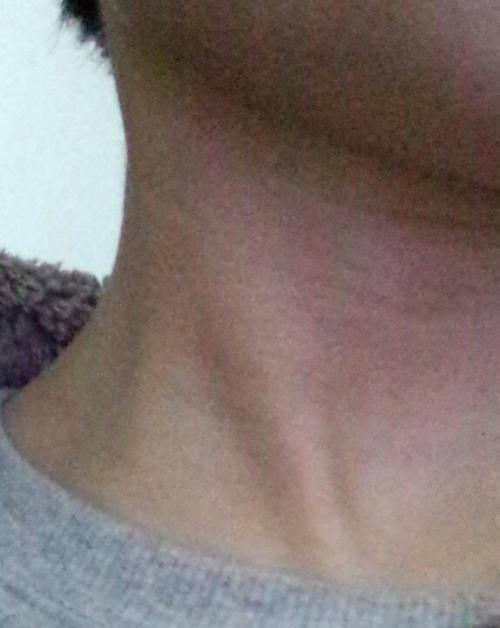 脖子正前方靠下右边的筋明显粗大肿大不疼不痒是怎么回事