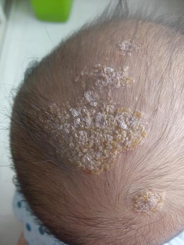 最好多注意,时间长了会出现问题,我家宝宝头上最后感染了,成了脂溢性