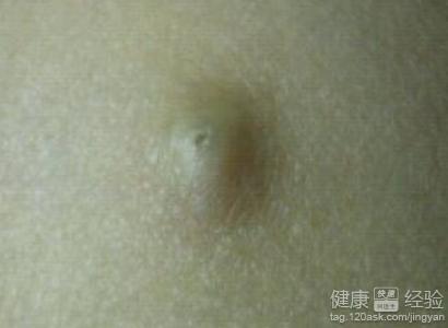 需要进行诊治还有护理,对于患有脂肪瘤之后经常会出现疼痛难忍的症状