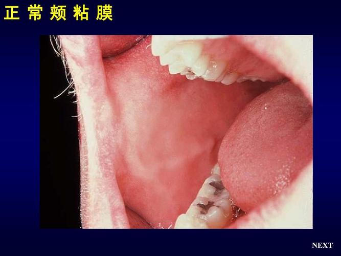 免费文档 所有分类 医药卫生 基础医学 黏膜病概论ppt 正常颊粘膜
