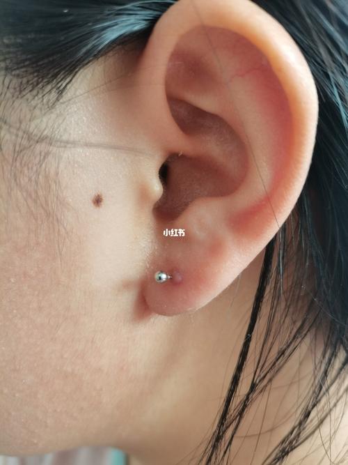 打耳洞之后耳朵旁边鼓了小包0101_耳洞_发炎_消炎