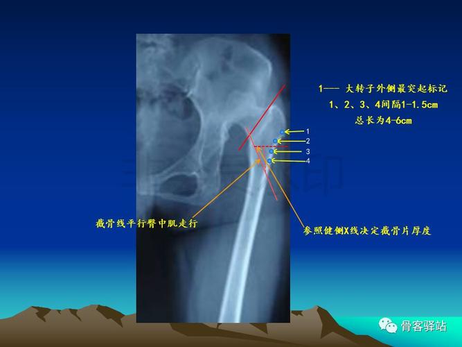 大转子延长截骨(eto)—股骨近端畸形髋重建必备技能