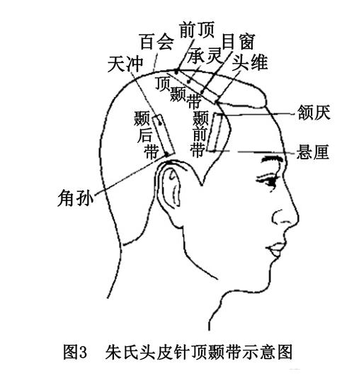 三家头皮针专长的临床体会教程.doc 10页