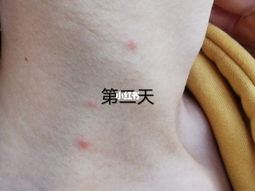 18发现第一颗水痘在小腹 不小心挠破了以为就是个痘痘 就没在意  第二