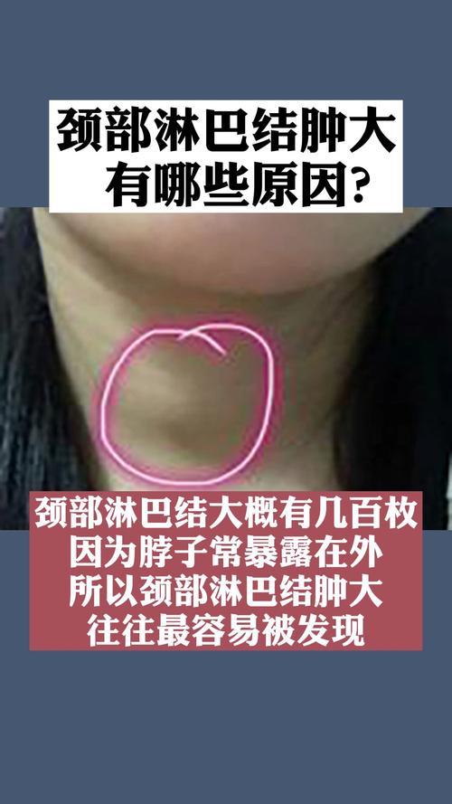 颈部淋巴结肿大有什么原因呢